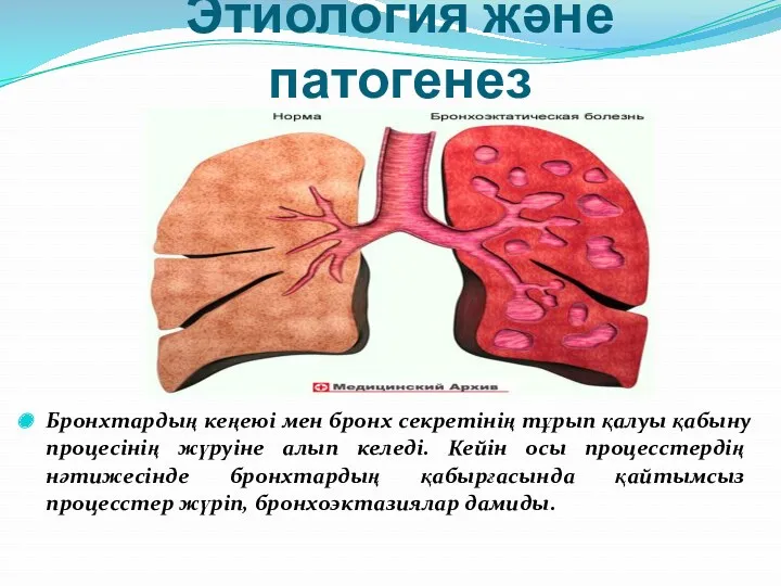 Этиология және патогенез Бронхтардың кеңеюі мен бронх секретінің тұрып қалуы