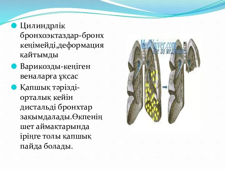 Цилиндрлік бронхоэктаздар-бронх кеңімейді,деформация қайтымды Варикозды-кеңіген веналарға ұқсас Қапшық тәрізді-орталық кейін