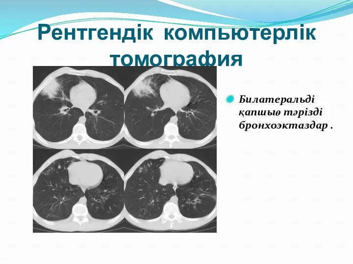 Рентгендік компьютерлік томография Билатеральді қапшыө тәрізді бронхоэктаздар .