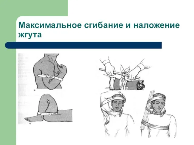 Максимальное сгибание и наложение жгута