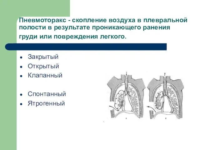 Пневмоторакс - скопление воздуха в плевральной полости в результате проникающего