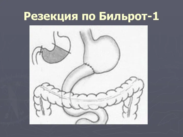 Резекция по Бильрот-1