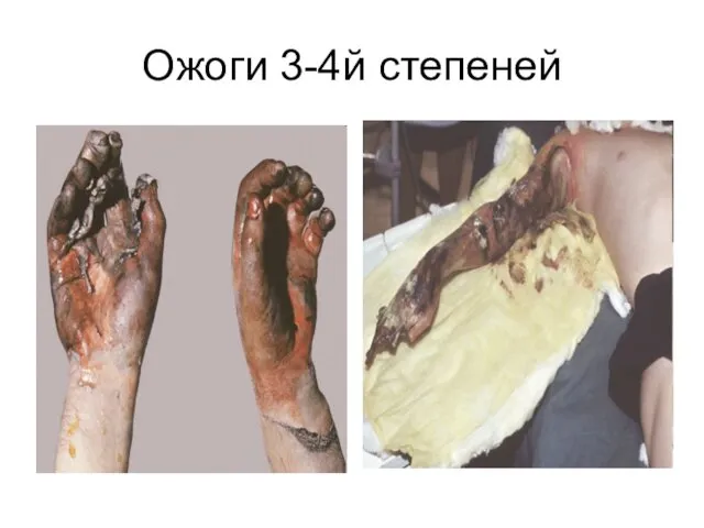 Ожоги 3-4й степеней