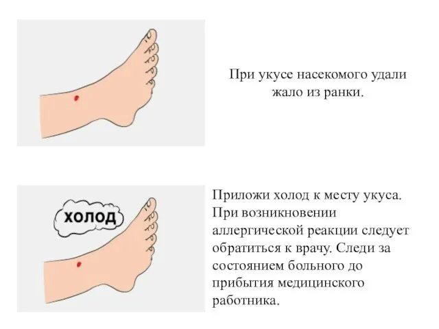 При укусе насекомого удали жало из ранки. Приложи холод к