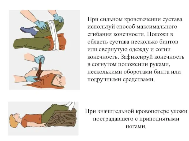 При сильном кровотечении сустава используй способ максимального сгибания конечности. Положи