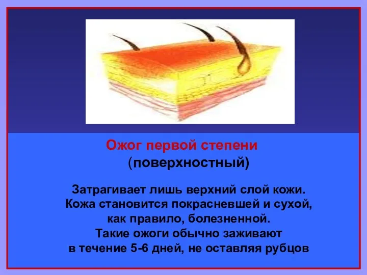 Ожог первой степени (поверхностный) Затрагивает лишь верхний слой кожи. Кожа