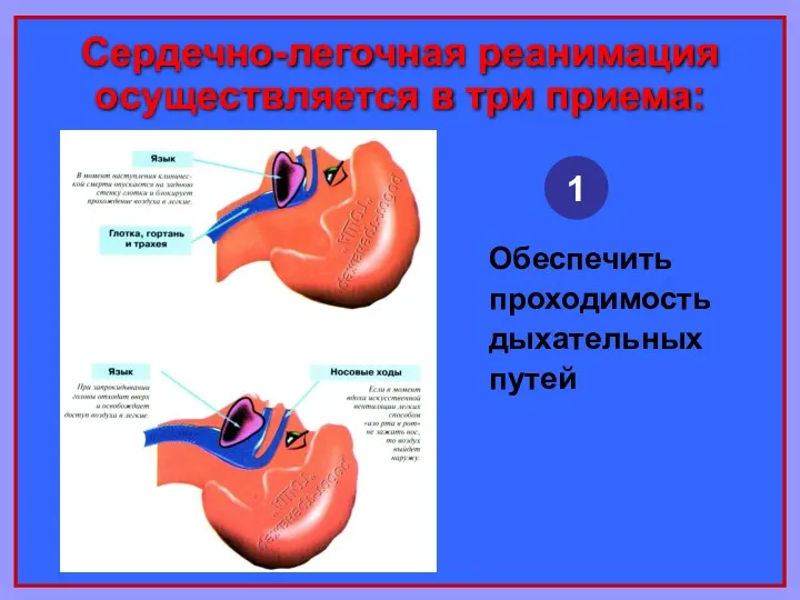 Сердечно-легочная реанимация осуществляется в три приема: Обеспечить проходимость дыхательных путей 1