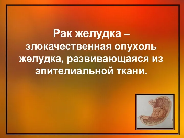 Рак желудка – злокачественная опухоль желудка, развивающаяся из эпителиальной ткани.