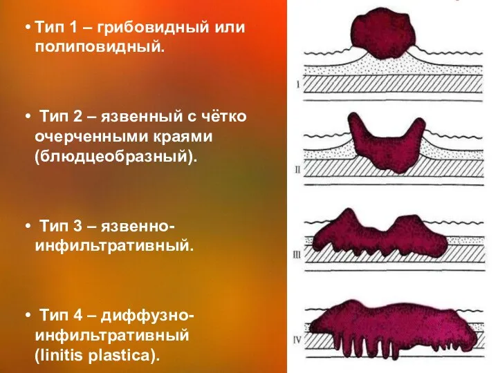 Тип 1 – грибовидный или полиповидный. Тип 2 – язвенный