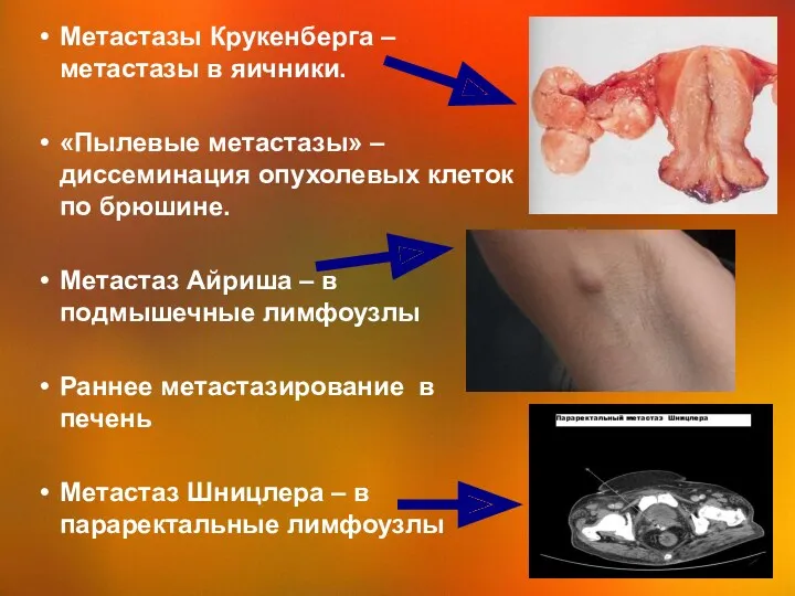 Метастазы Крукенберга – метастазы в яичники. «Пылевые метастазы» – диссеминация