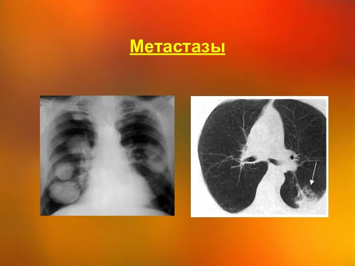 Метастазы