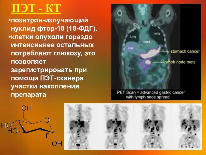 ПЭТ - КТ позитрон-излучающий нуклид фтор-18 (18-ФДГ). клетки опухоли гораздо