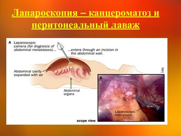 Лапароскопия – канцероматоз и перитонеальный лаваж