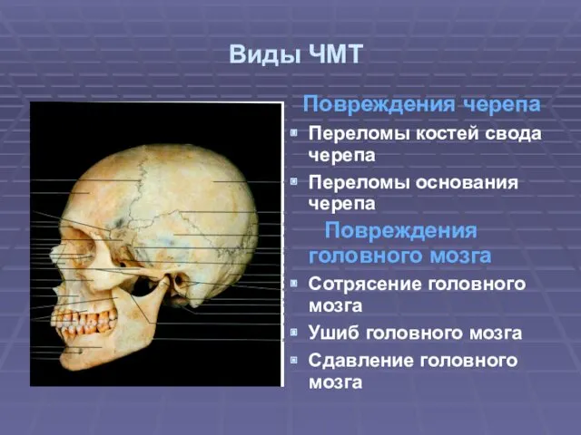 Виды ЧМТ Повреждения черепа Переломы костей свода черепа Переломы основания