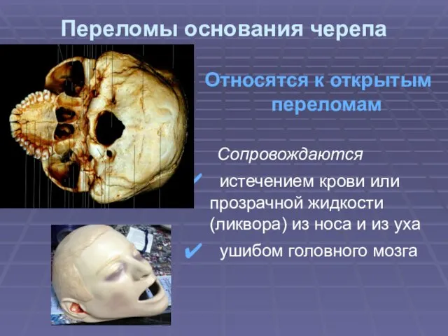 Переломы основания черепа Относятся к открытым переломам Сопровождаются истечением крови