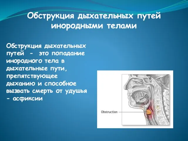 Обструкция дыхательных путей инородными телами Обструкция дыхательных путей - это