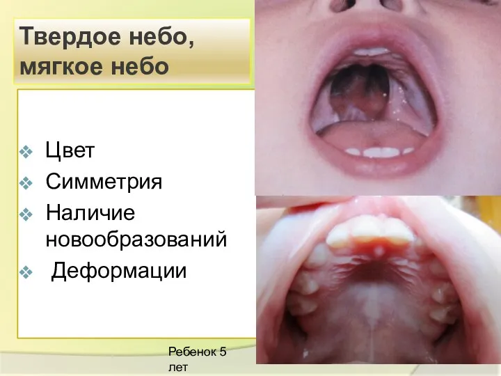 Цвет Симметрия Наличие новообразований Деформации Твердое небо, мягкое небо Ребенок 5 лет