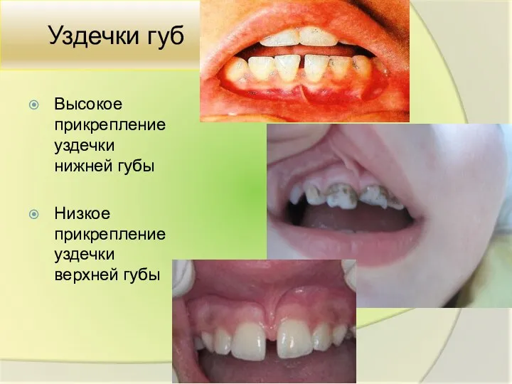 Уздечки губ Высокое прикрепление уздечки нижней губы Низкое прикрепление уздечки верхней губы