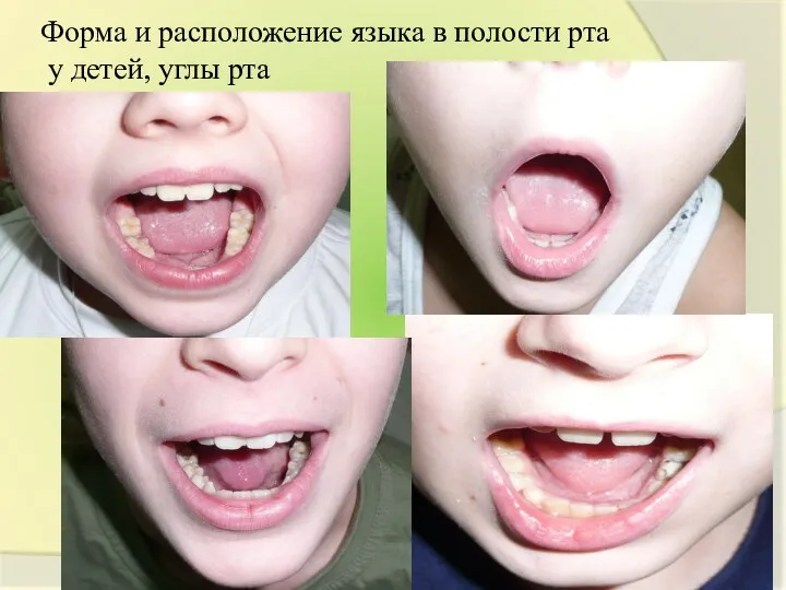 Форма и расположение языка в полости рта у детей, углы рта