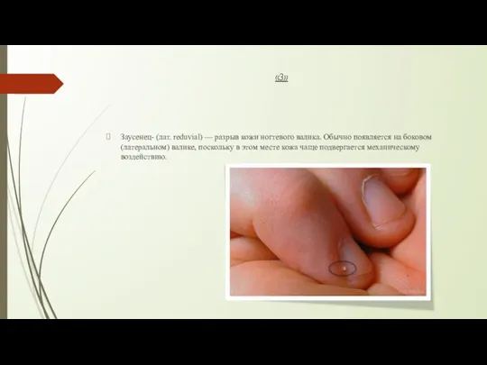 «З» Заусенец- (лат. reduvial) — разрыв кожи ногтевого валика. Обычно