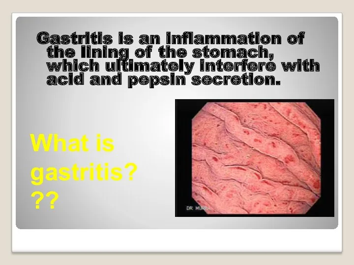 What is gastritis??? Gastritis is an inflammation of the lining