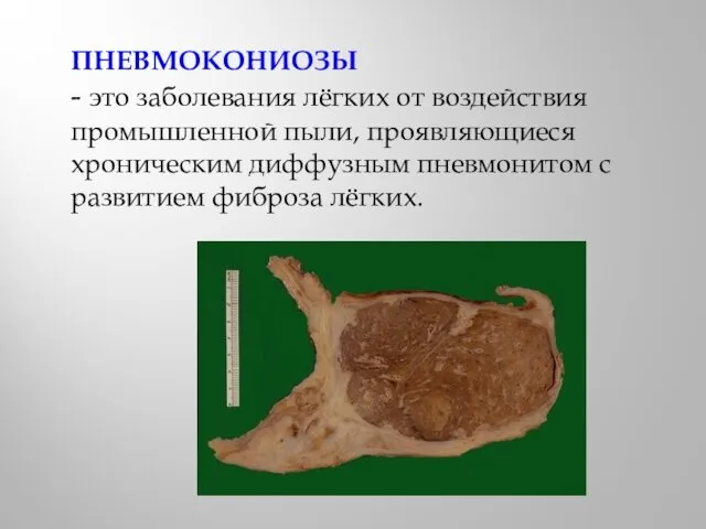 ПНЕВМОКОНИОЗЫ - это заболевания лёгких от воздействия промышленной пыли, проявляющиеся