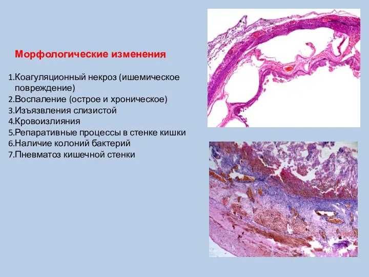 Морфологические изменения Коагуляционный некроз (ишемическое повреждение) Воспаление (острое и хроническое)