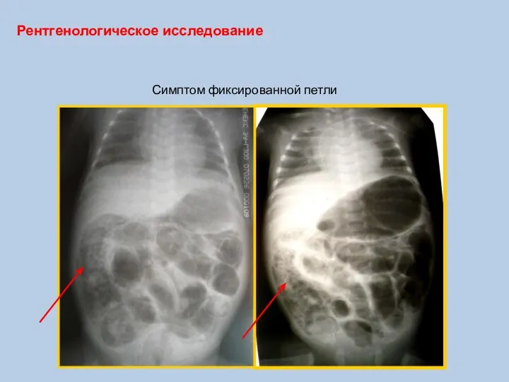 Рентгенологическое исследование Симптом фиксированной петли