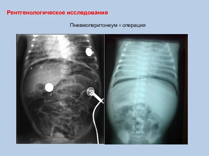 Пневмоперитонеум = операция Рентгенологическое исследование