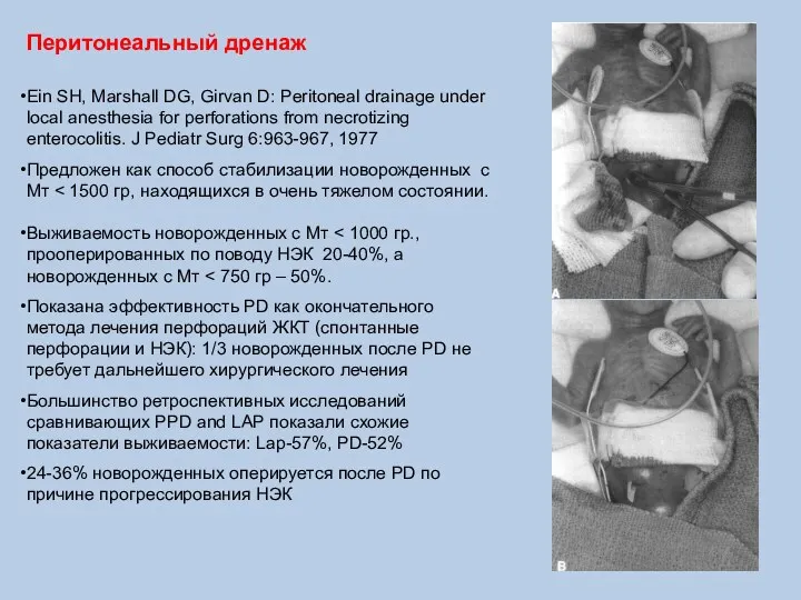 Перитонеальный дренаж Ein SH, Marshall DG, Girvan D: Peritoneal drainage