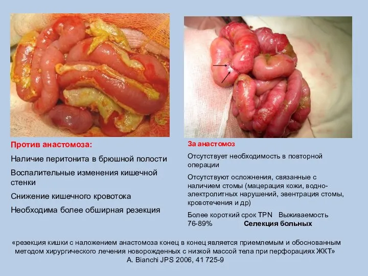 Против анастомоза: Наличие перитонита в брюшной полости Воспалительные изменения кишечной