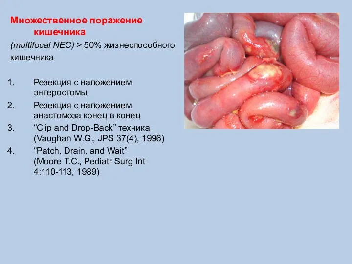 Множественное поражение кишечника (multifocal NEC) > 50% жизнеспособного кишечника Резекция
