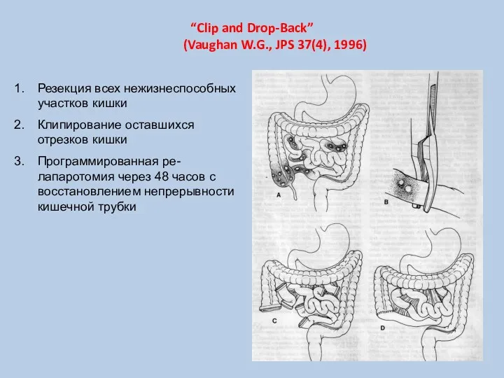“Clip and Drop-Back” (Vaughan W.G., JPS 37(4), 1996) Резекция всех