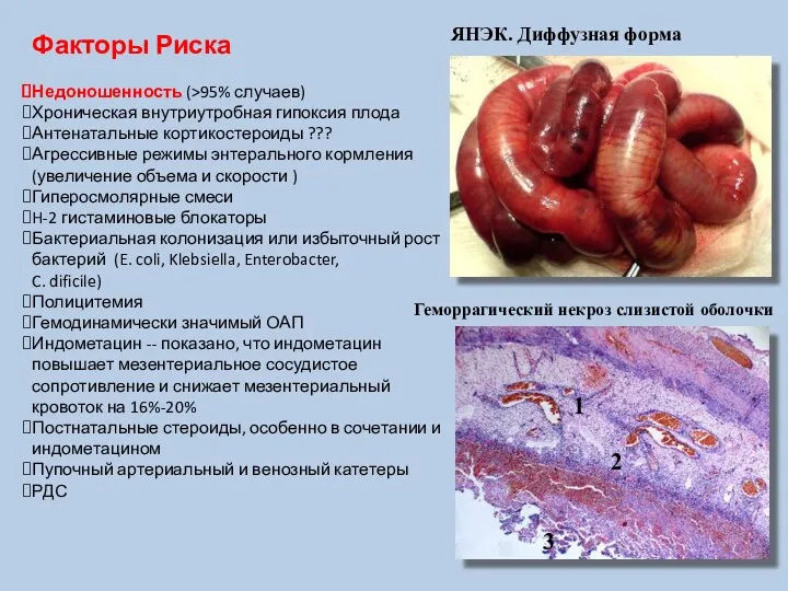 Факторы Риска Недоношенность (>95% случаев) Хроническая внутриутробная гипоксия плода Антенатальные