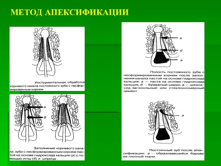 МЕТОД АПЕКСИФИКАЦИИ