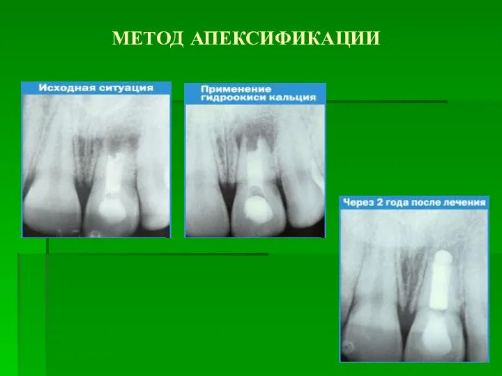 МЕТОД АПЕКСИФИКАЦИИ