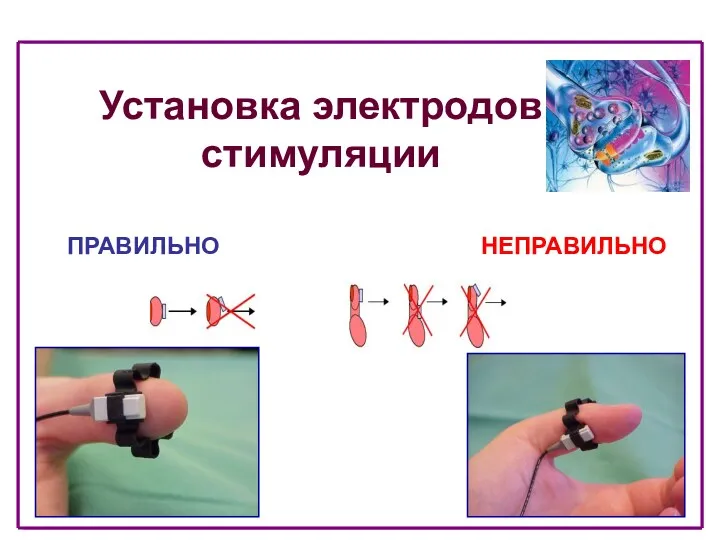 Установка электродов стимуляции ПРАВИЛЬНО НЕПРАВИЛЬНО