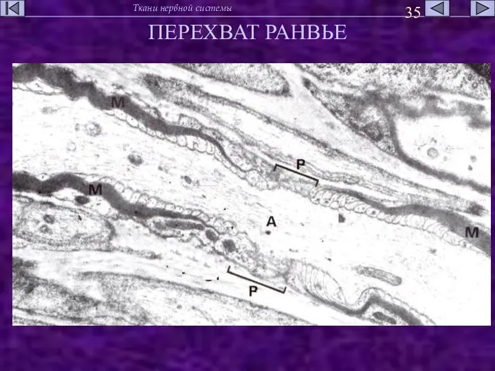 ПЕРЕХВАТ РАНВЬЕ