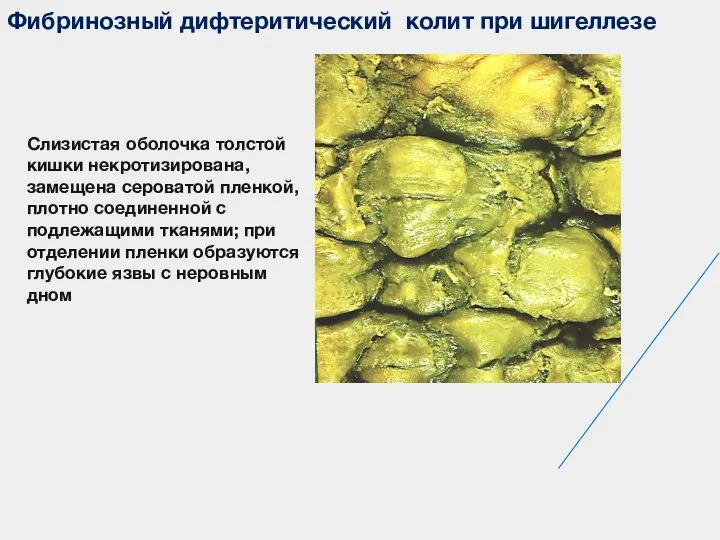 Фибринозный дифтеритический колит при шигеллезе Слизистая оболочка толстой кишки некротизирована,