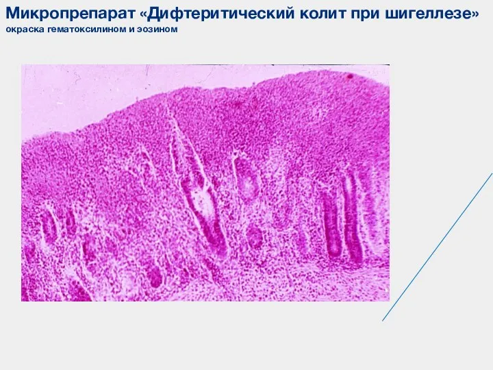 Микропрепарат «Дифтеритический колит при шигеллезе» окраска гематоксилином и эозином