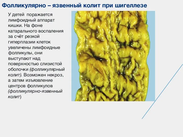 Фолликулярно – язвенный колит при шигеллезе У детей поражается лимфоидный