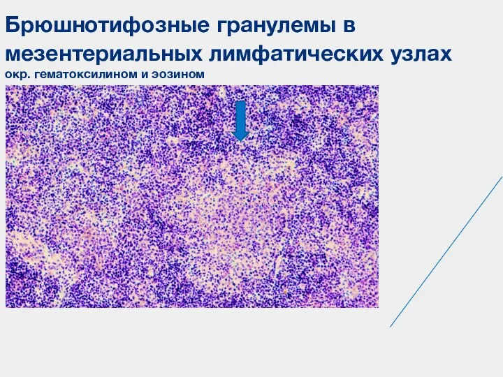 Брюшнотифозные гранулемы в мезентериальных лимфатических узлах окр. гематоксилином и эозином