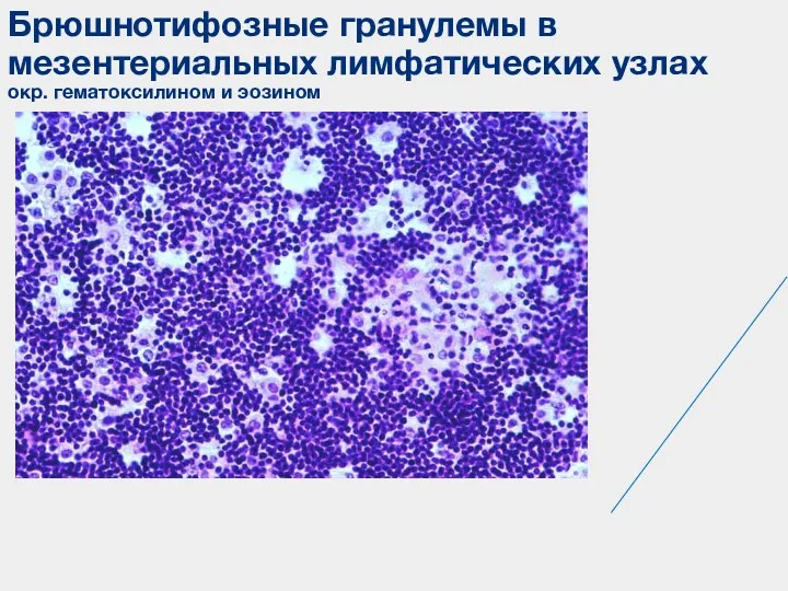 Брюшнотифозные гранулемы в мезентериальных лимфатических узлах окр. гематоксилином и эозином