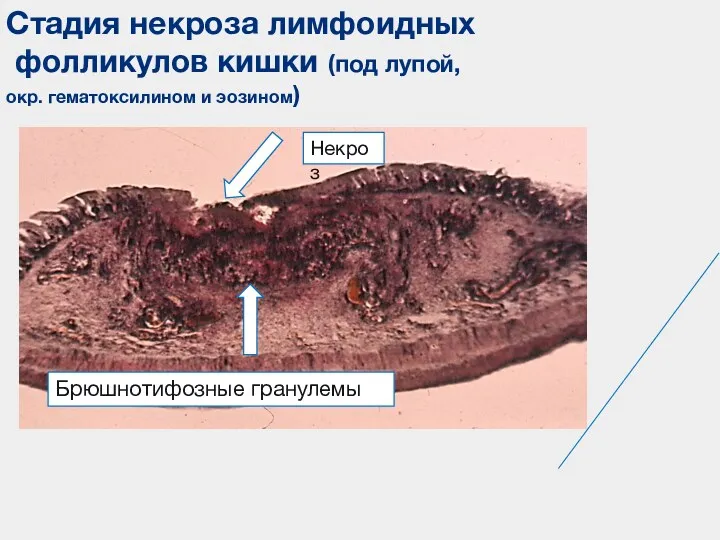 Брюшнотифозные гранулемы Стадия некроза лимфоидных фолликулов кишки (под лупой, окр. гематоксилином и эозином) Некроз