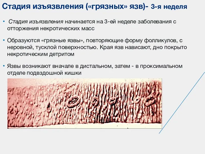 Стадия изъязвления начинается на 3-ей неделе заболевания с отторжения некротических