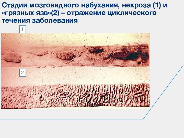 Стадии мозговидного набухания, некроза (1) и «грязных язв»(2) – отражение циклического течения заболевания 1 2