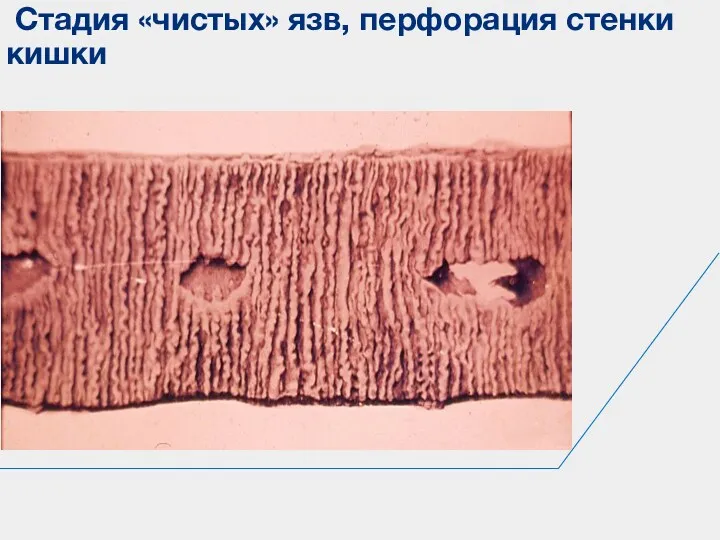 Стадия «чистых» язв, перфорация стенки кишки