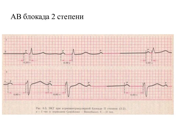 АВ блокада 2 степени