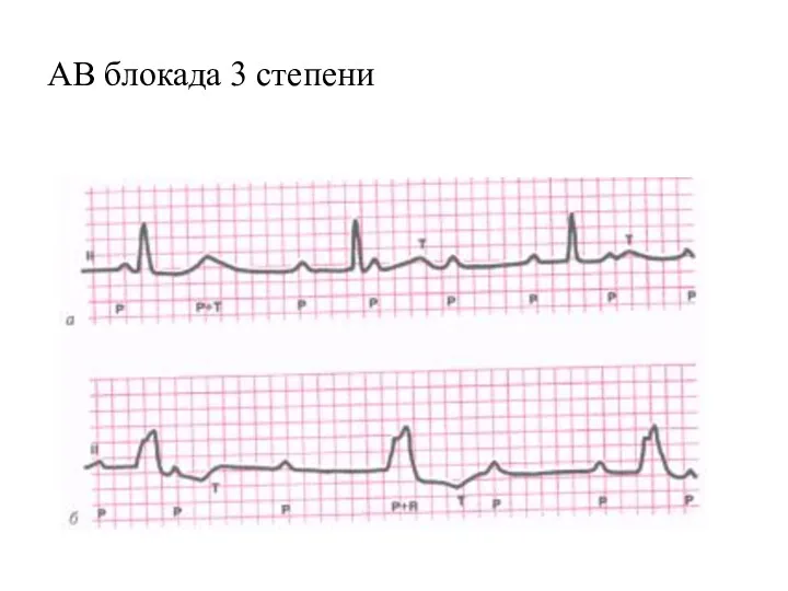 АВ блокада 3 степени