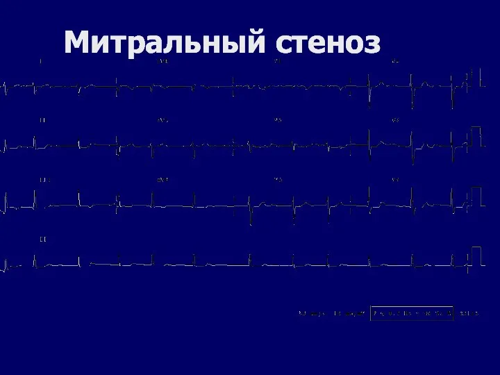 Митральный стеноз